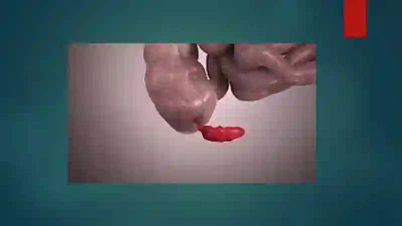 Appenditsit 3