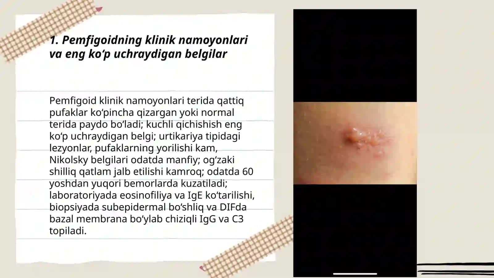 Pemfigoid. Klinikasi, tashxisi, davolash 3
