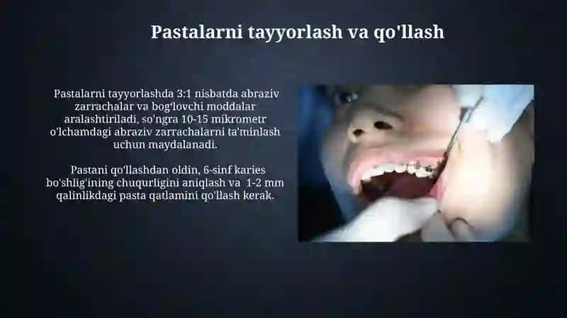 6-sinf karies kovaklarini charxlashning o'ziga xostomonlari 3