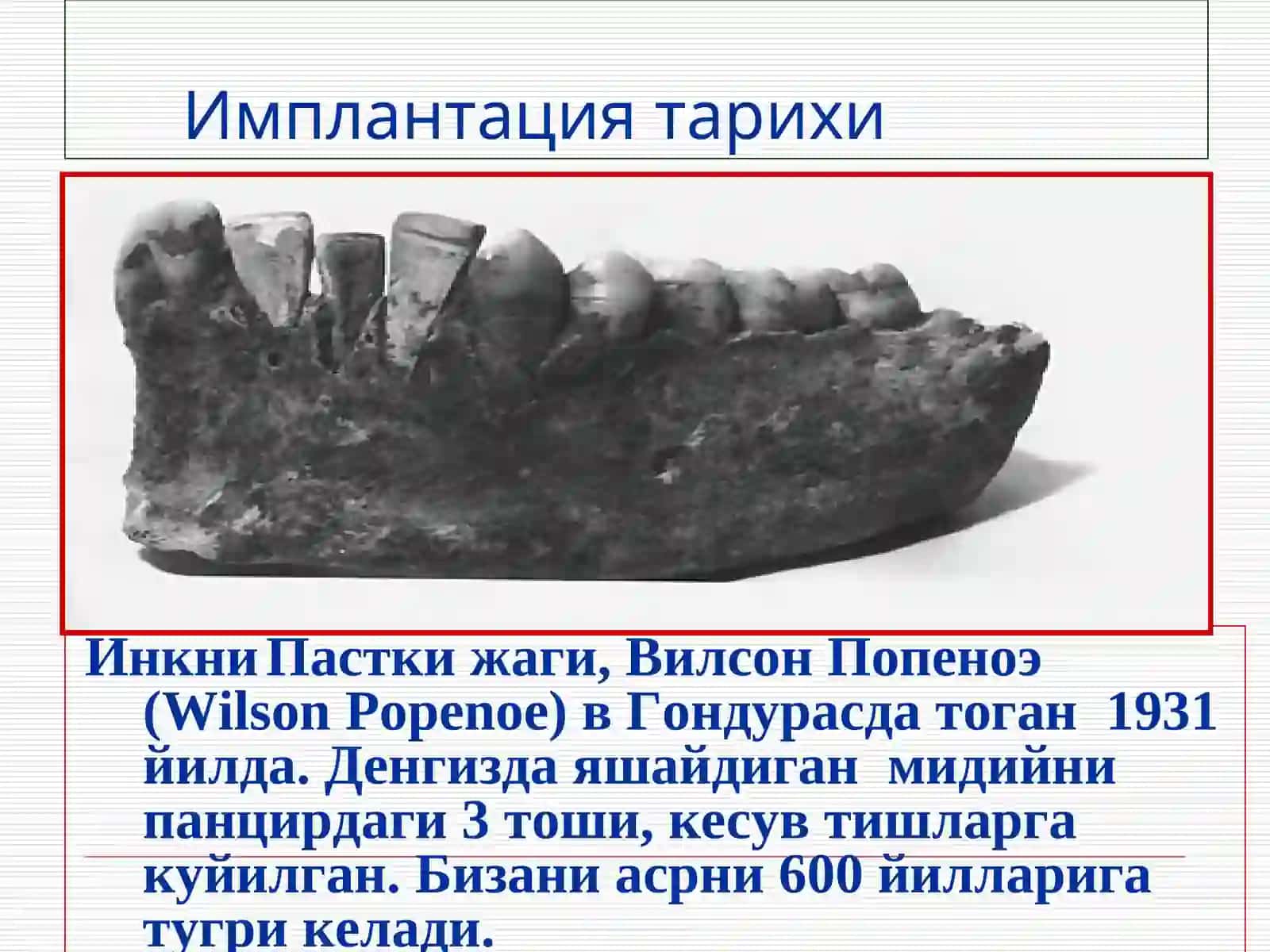 Дентал имплантация тарихи 3
