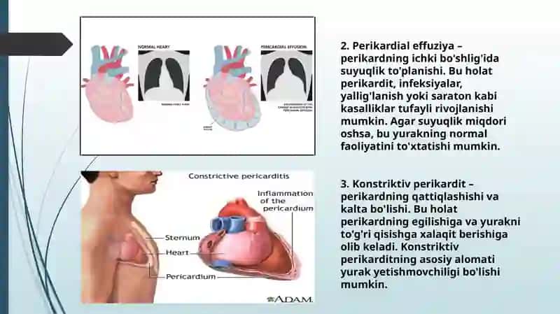 Perikard kasalliklari. Yurak o‘smalari 3