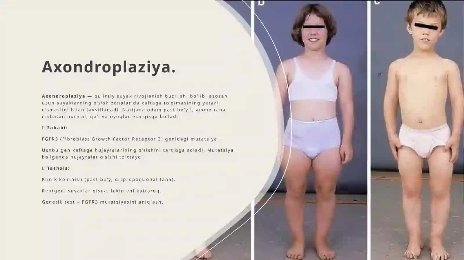 Suyaklar rivojlanishi buzilishi sinishlar.osteonekroz 4