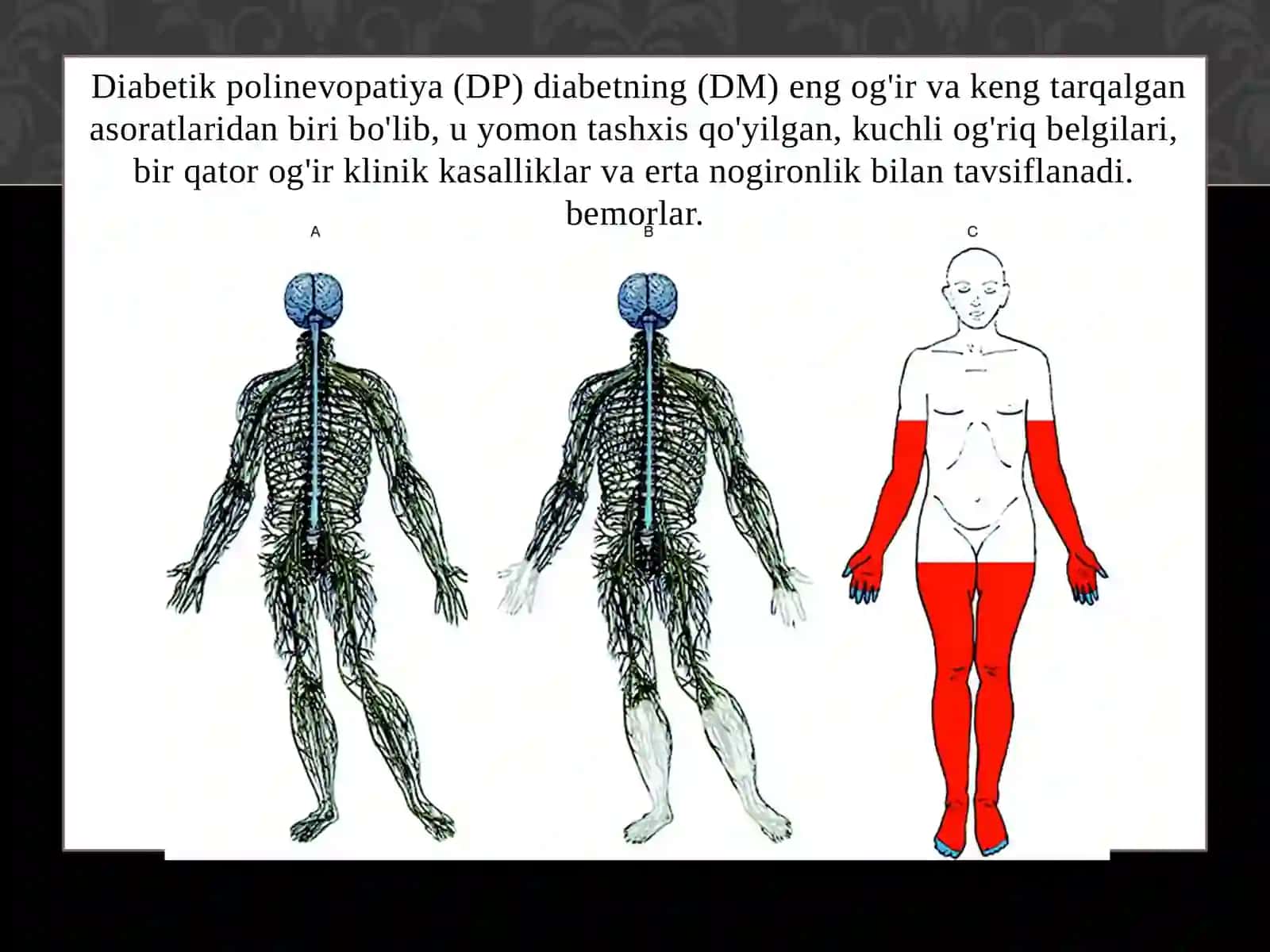 Diabetik nevopatiya 4