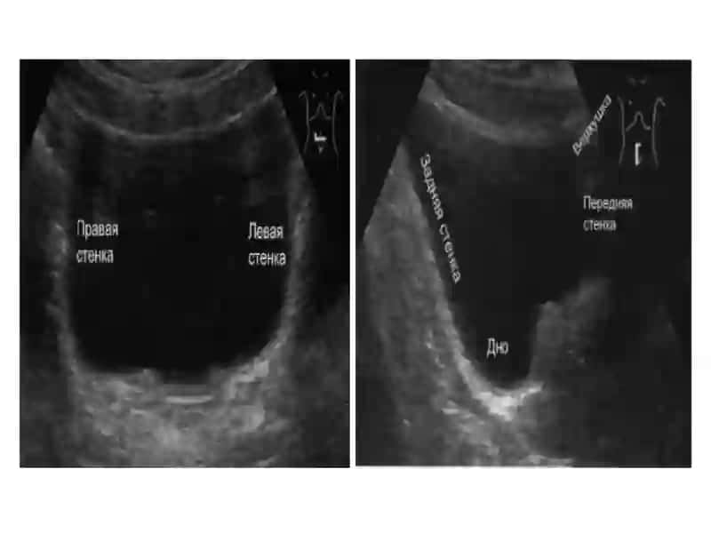 Quviq kasalliklarini ultratovush diagnostikasi 4