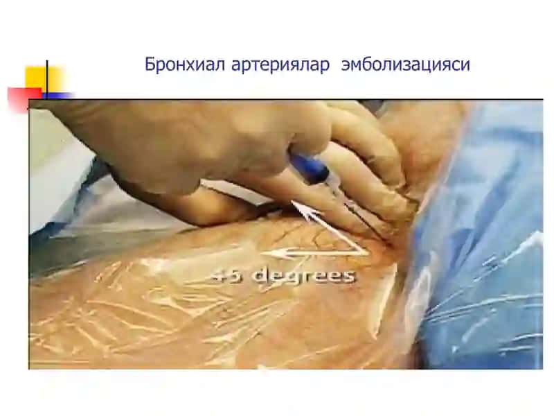 Упка абсцесси 4