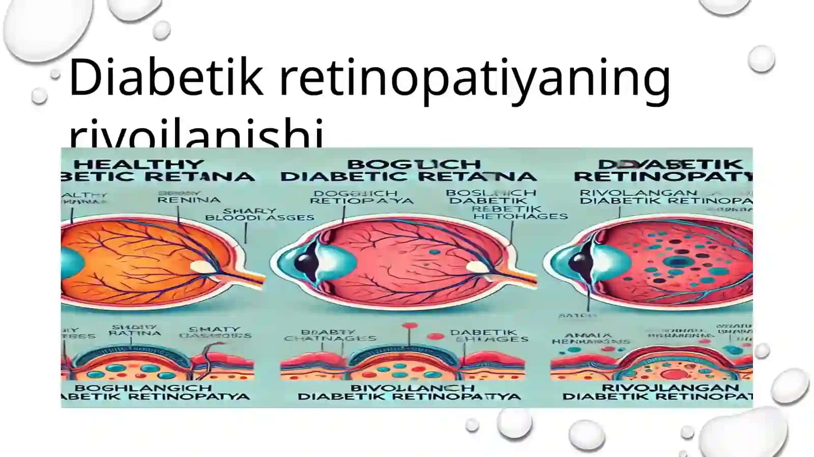 Diabetik retinopatiya 4