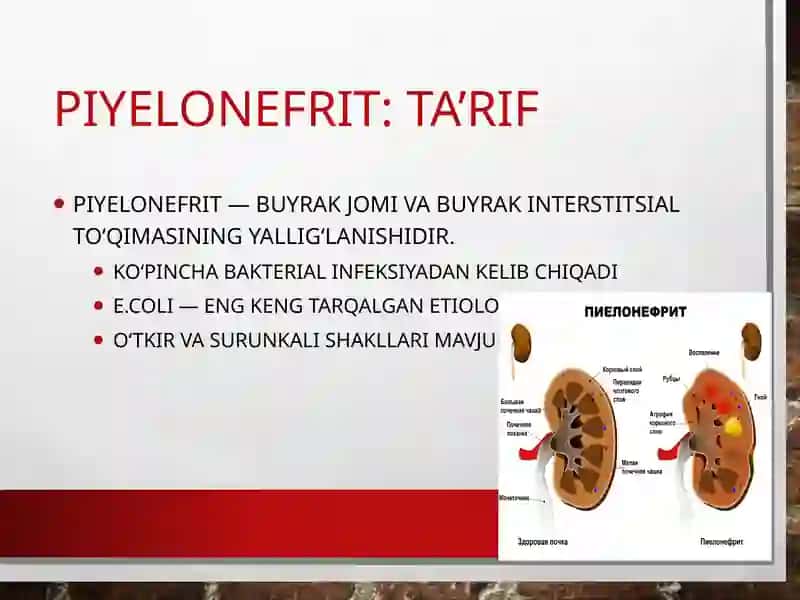 Buyrak kasalliklari.Piyelonefrit. 4