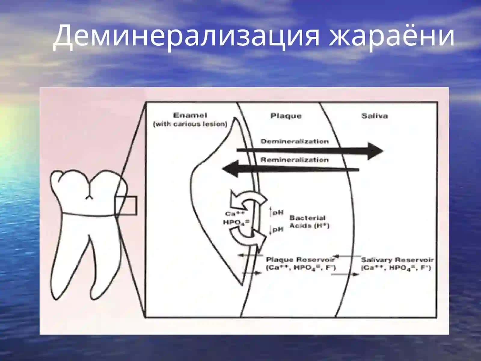 Кариес ҳақида тушунча 4