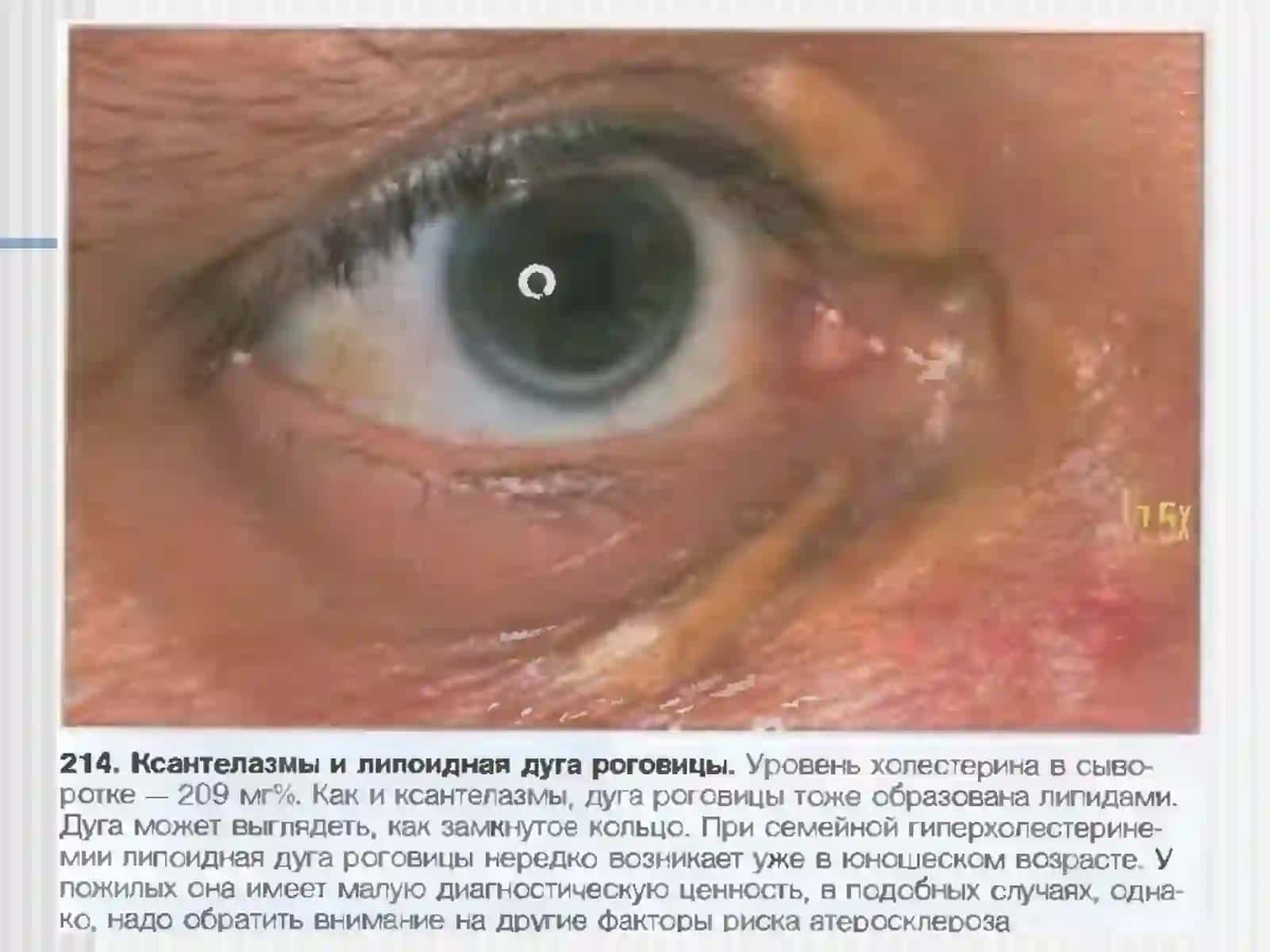 Атеросклероз 4
