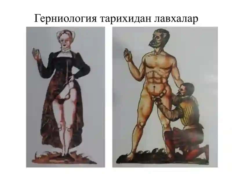 Қорин чурраларива унинг асоратлари 4