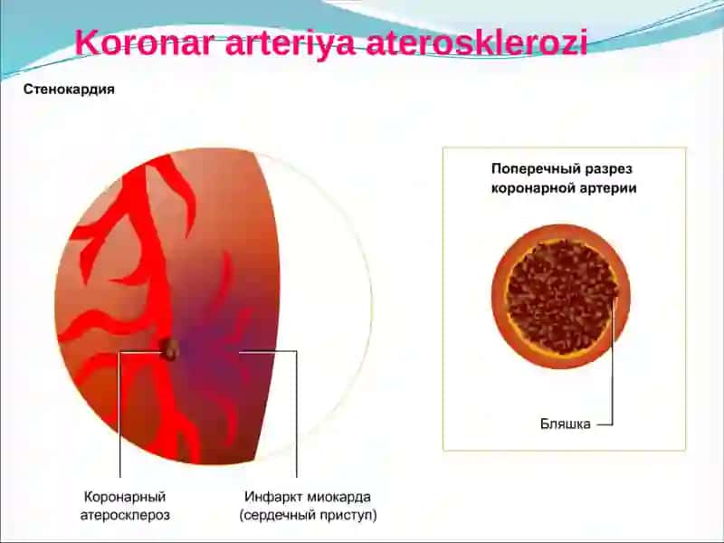 Юрак ишемик касаллиги 4
