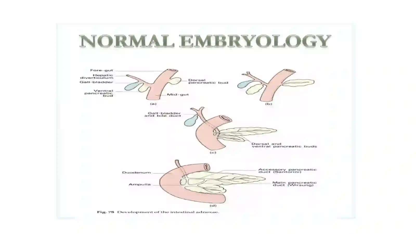 Annular pancreas / Taqasimon oshqozonosti bezi 4