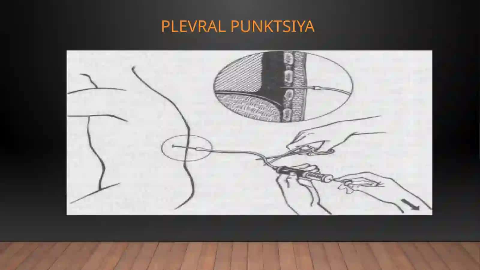 KO`KRAK QAFASIDAGI OPERATSIYALAR PLEVRAL PUNKTSIYA 4