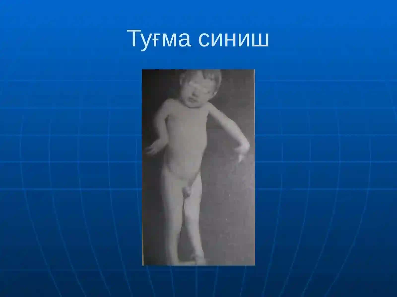 Suyaklarning sinishi va chiqishi 4