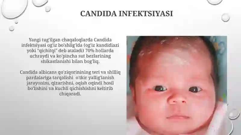 Yangi tug'ilgan chaqaloqlarda teri kasalliklari 4