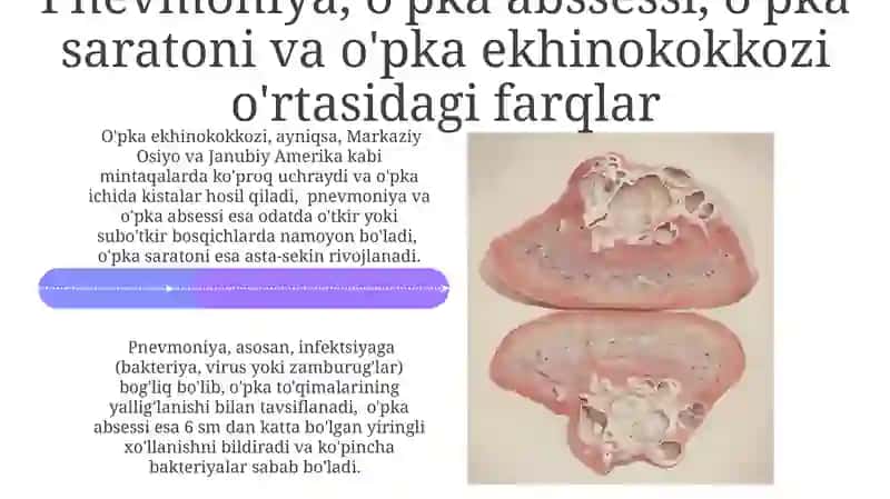O'pka Ekxinokokkozi 4