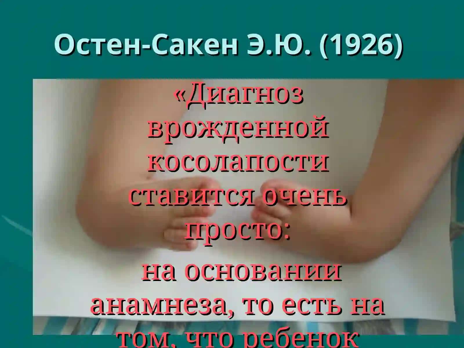 Врожденная косолапость (clubfoot) 4