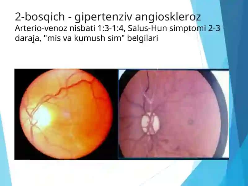 Umumiy kasalliklarida ko'rish organidagi o'zgarishlar 4