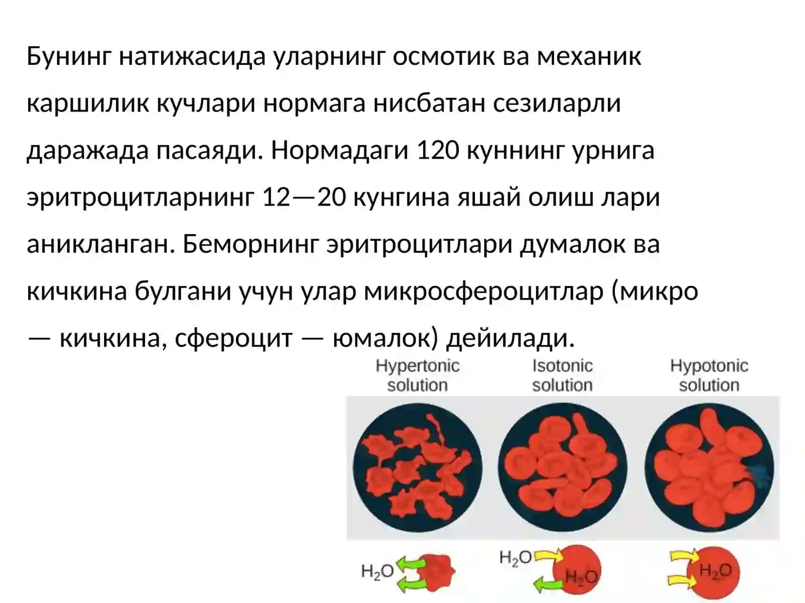 Ирсийсфероцитоз-МинковкийШаффаркасаллиги(gematologiya) 4