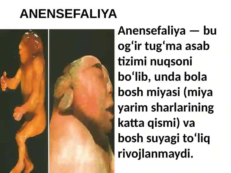 Tug‘ma anomaliyalar. Chala tug‘ilganlardagi buzilishlar 4