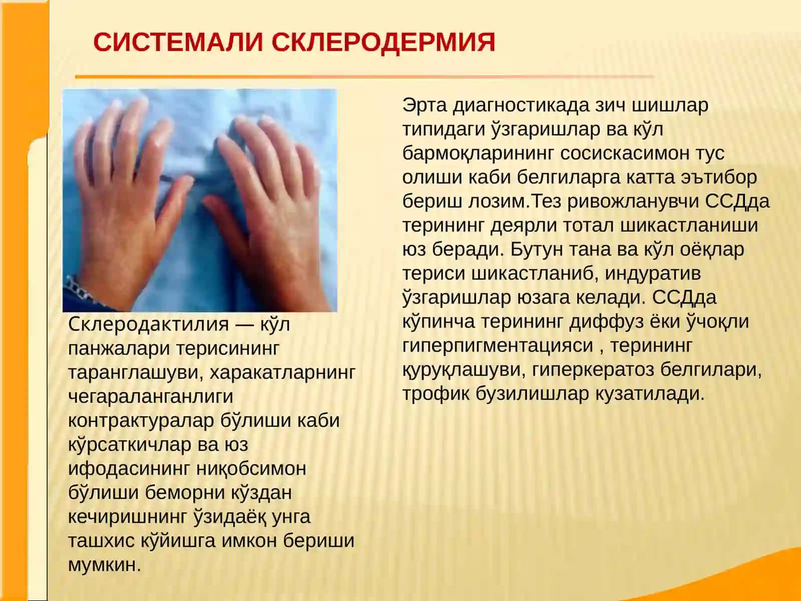 Системали склеродермия 4