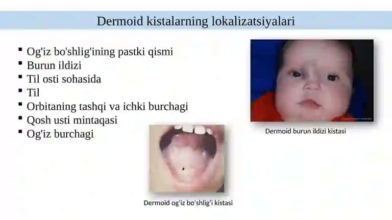 Yuz va bo‘yin kistalari 4