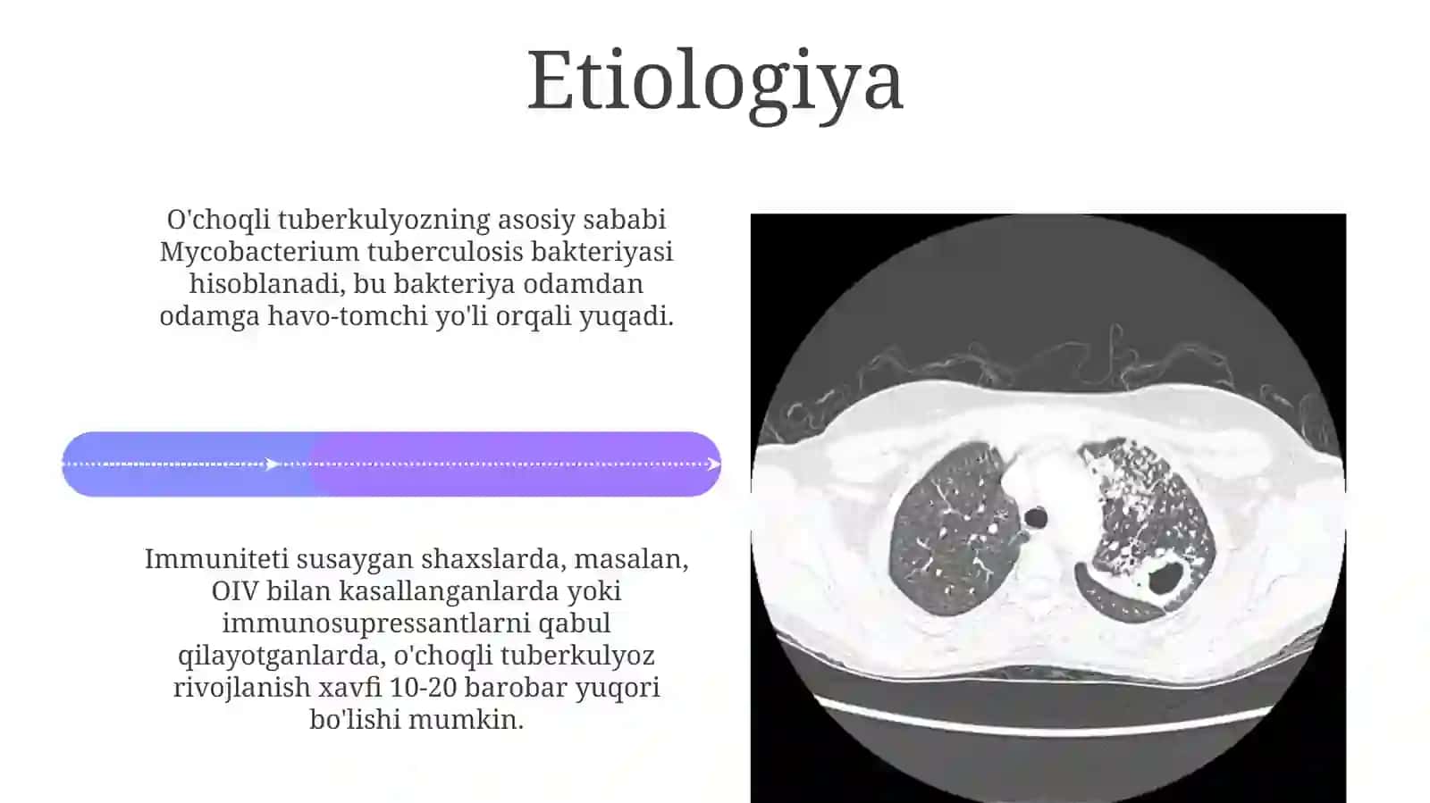 O‘pkaning o‘choqli, yallig'langan tuberkulyozi 4