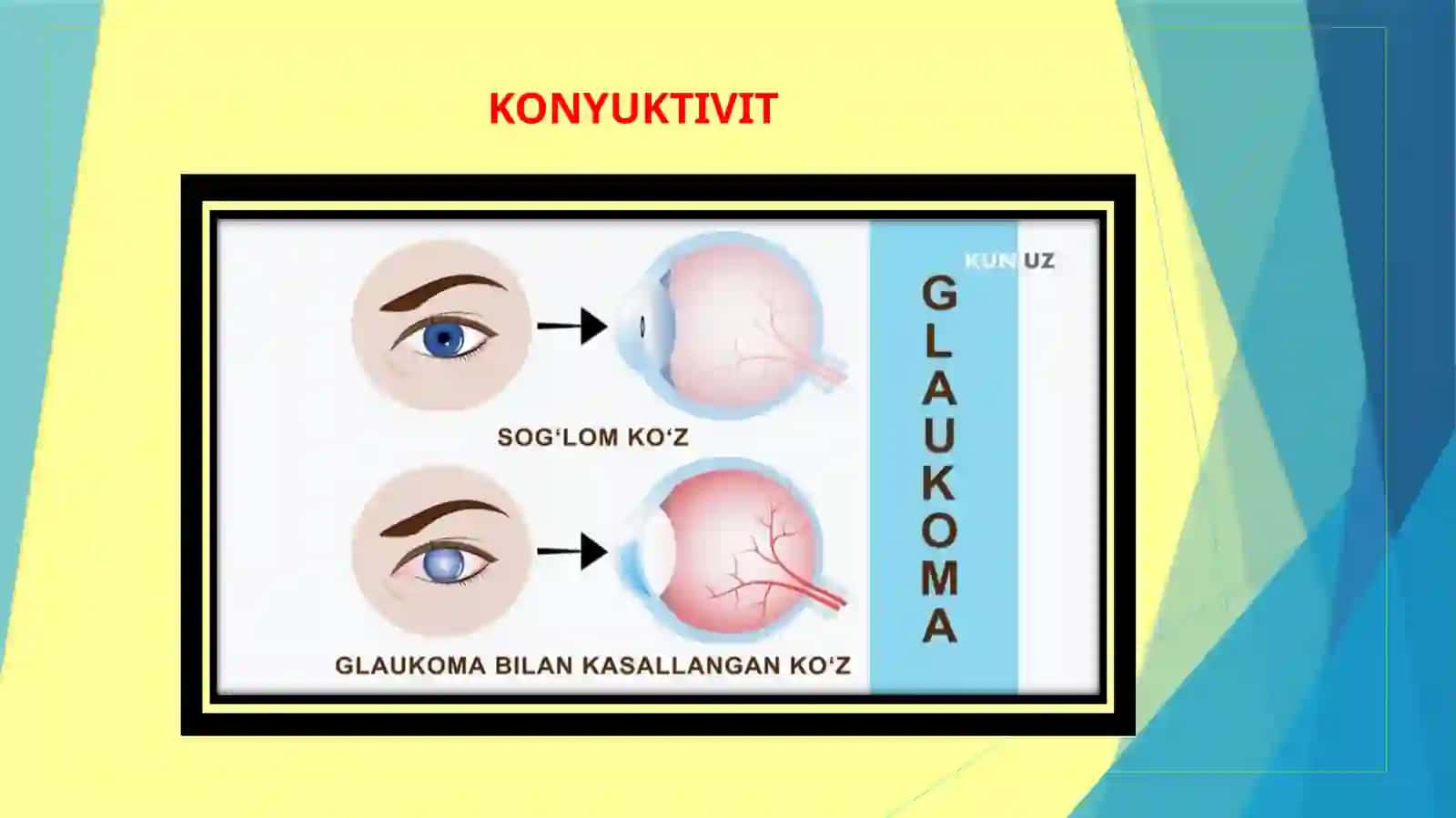 Glaukoma. Tug’ma glaukoma 4