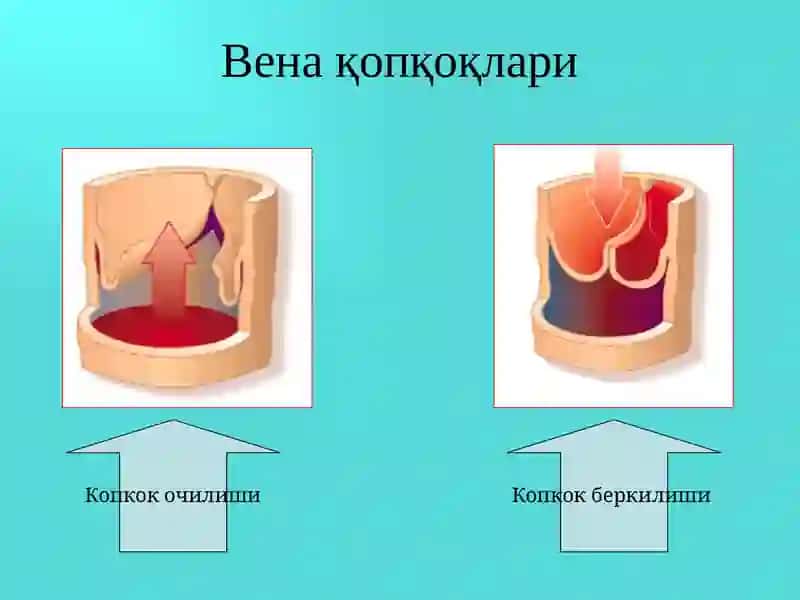 Оёқ веналарининг варикоз касаллиги 4