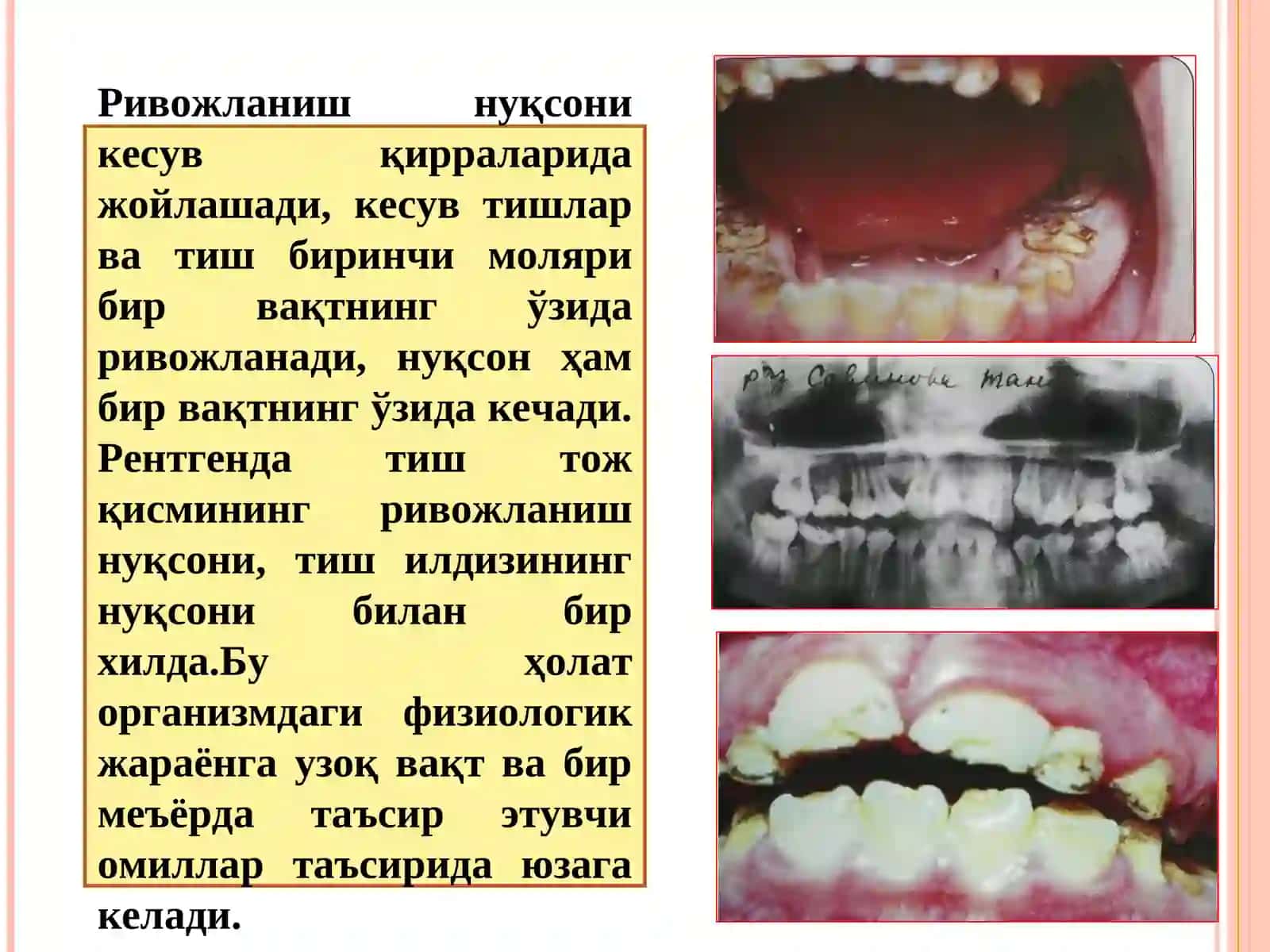 ТИШ РИВОЖЛАНИШИНГ НАСЛИЙ БУЗИЛИШИ 4