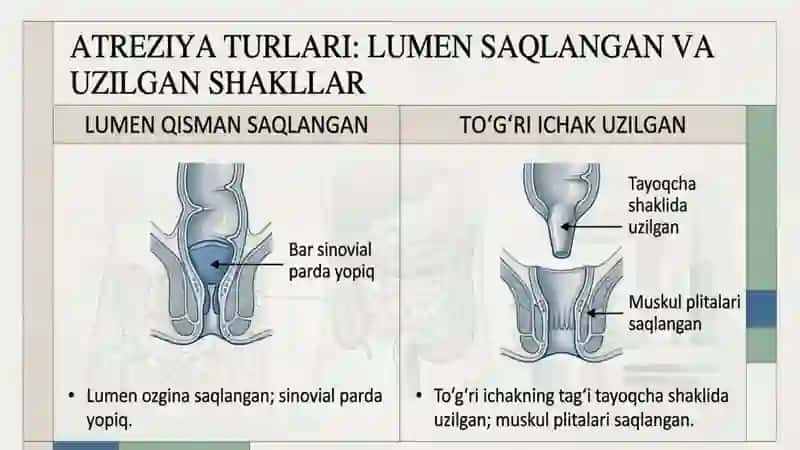 Toʻgʻri ichak va anal teshik atreziyalari 4