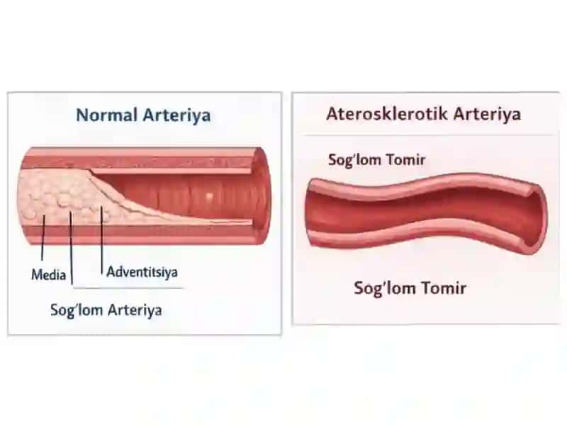 Arterioskleroz kasalligi 4