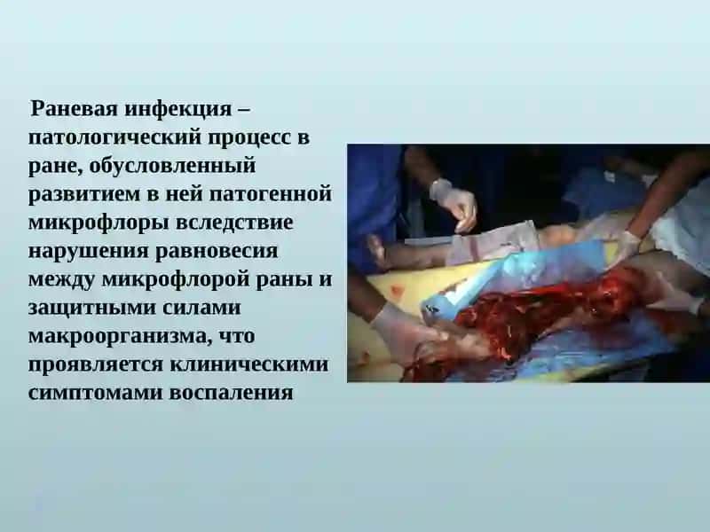 ИНФЕКЦИОННЫЕ ОСЛОЖНЕНИЯ ОГНЕСТРЕЛЬНЫХ РАН 4