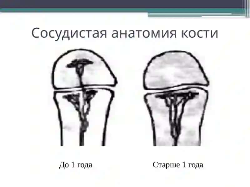 Острый гематогенный остеомиелит у детей 4