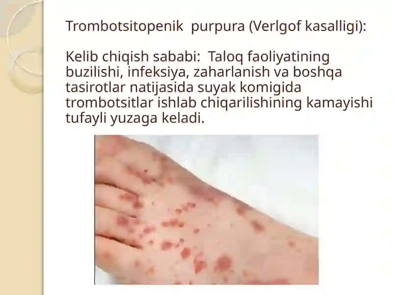 Tibbiyot. Gemorragik diatezlar 4