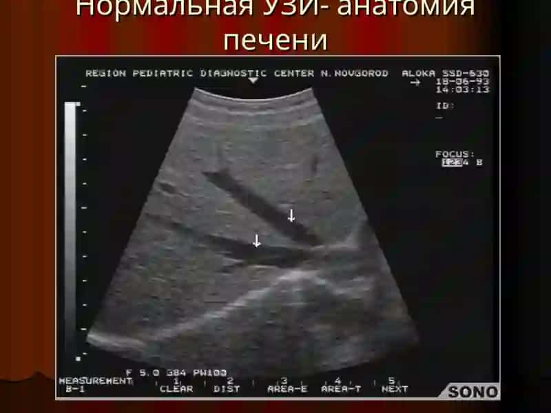 Лучевая диагностика заболеваний печени и желчевыводящих путей 4