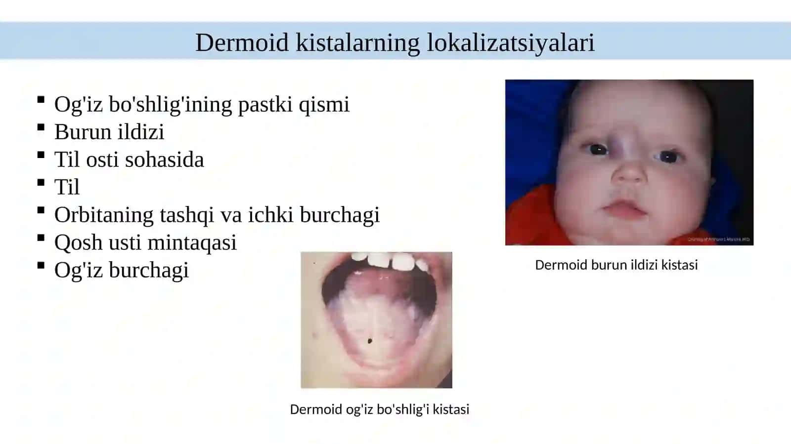Tug‘ma kistalar (epidermoid va dermoid kistalar) 4
