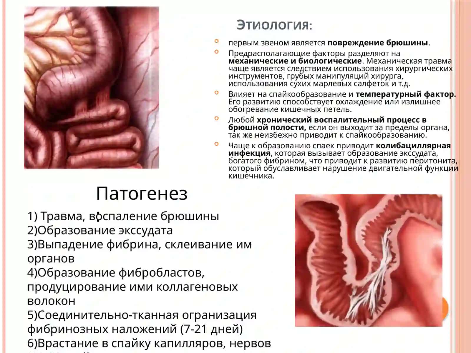Спаечная болезнь: Этиология, виды, лечение 4