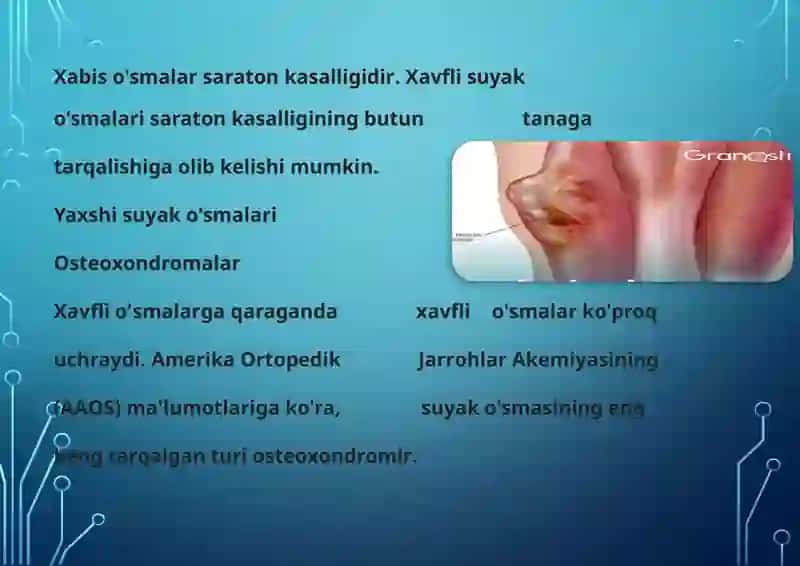 Suyak to'qimasi o'smalari 4