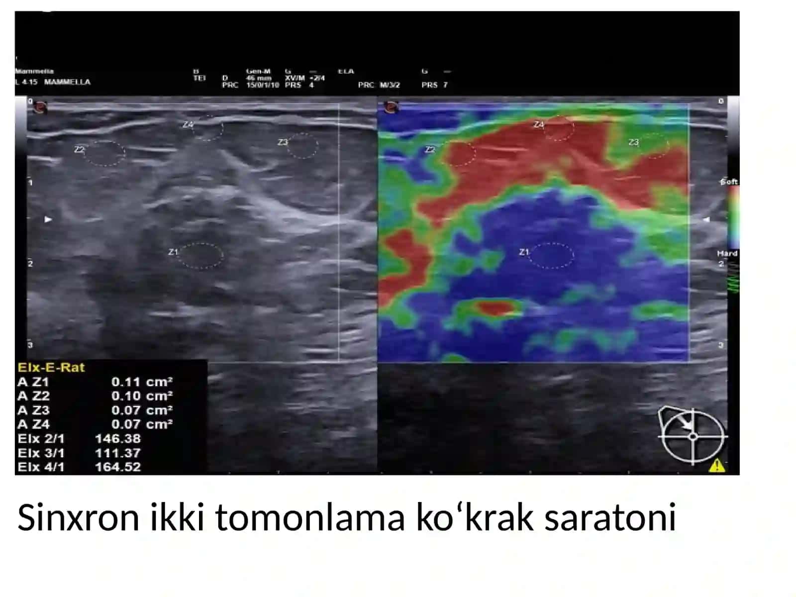 Elastografiya 4