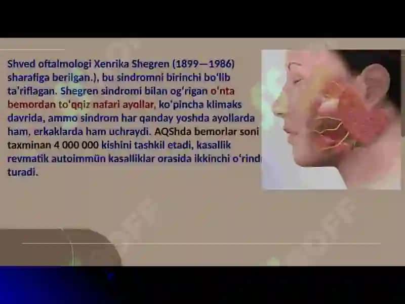 Shegren kasalligi 4