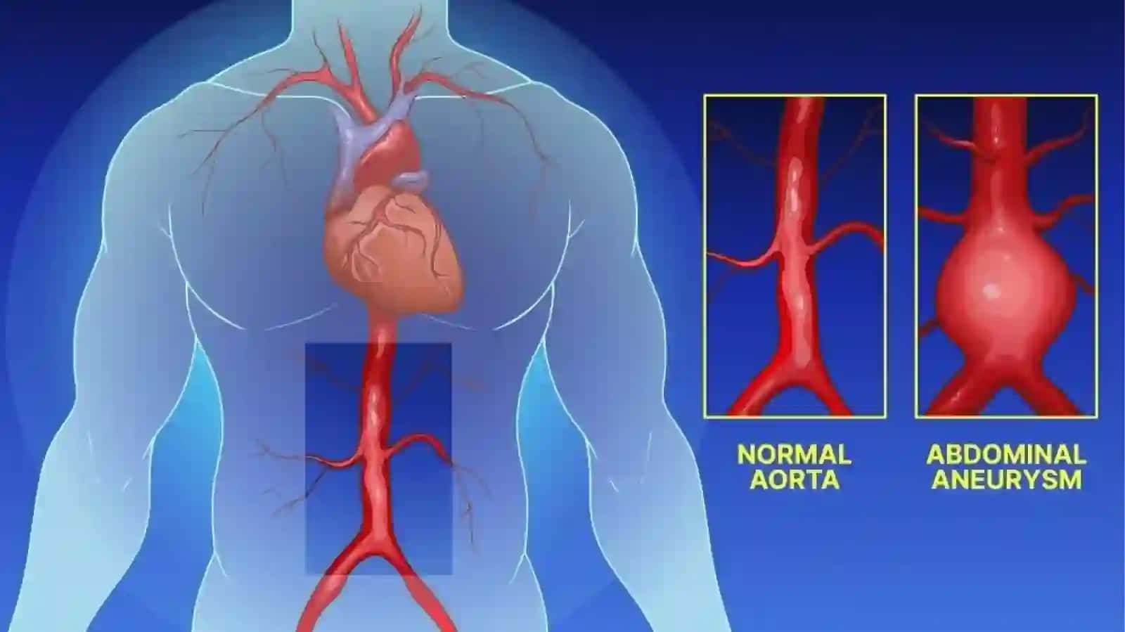 MAVZU: AORTA ANEVRIZMALARI 4