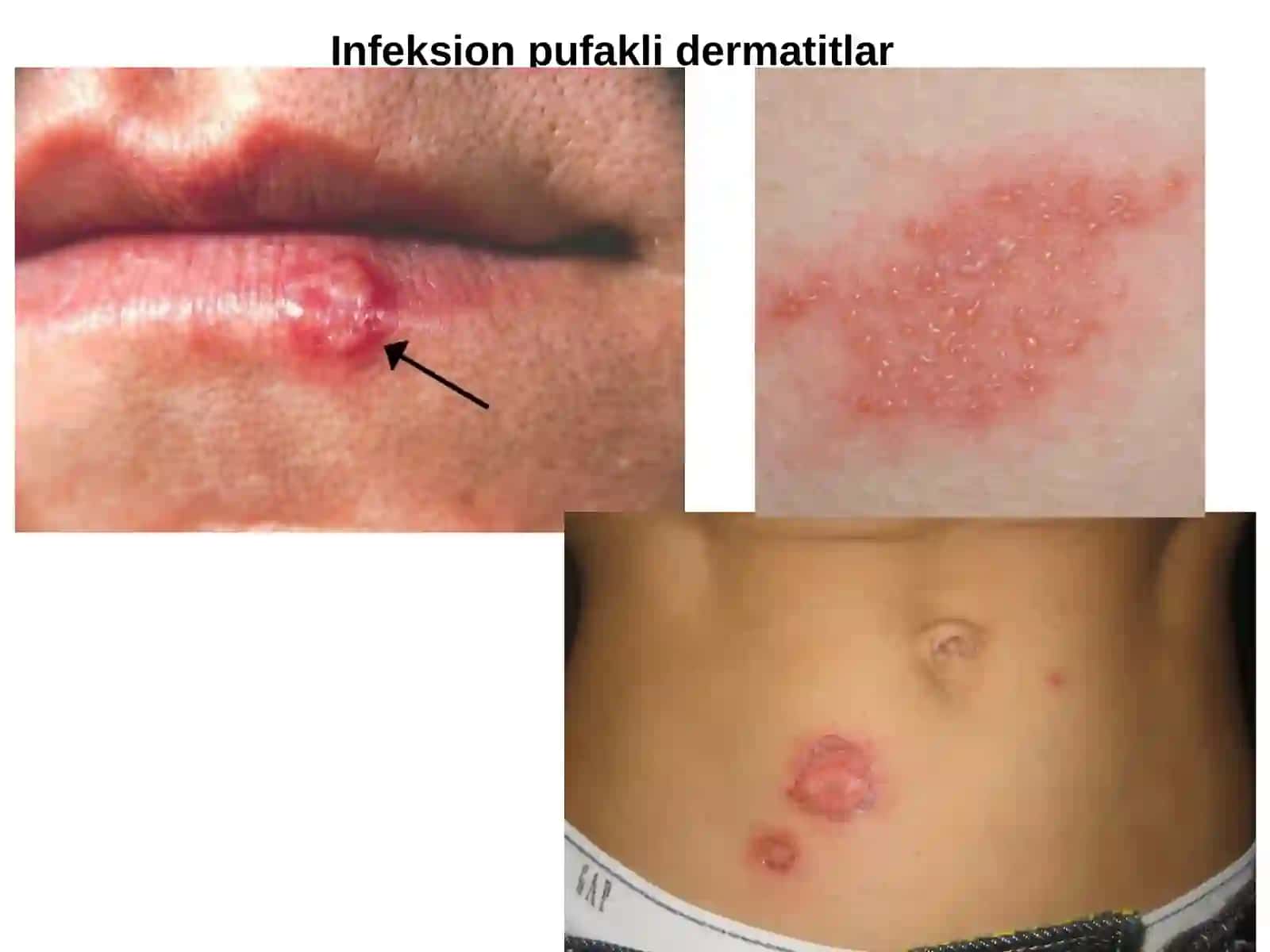 Pufakli dermatitlar klassifikatsiyasi.Diuring dermatiti,po’rsildoq yara 4
