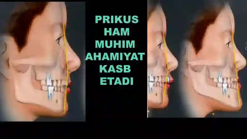 Ortopediyada tishlarni ustup bilan charxlash 4