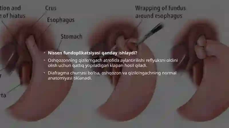 Diafragma churrasi 4