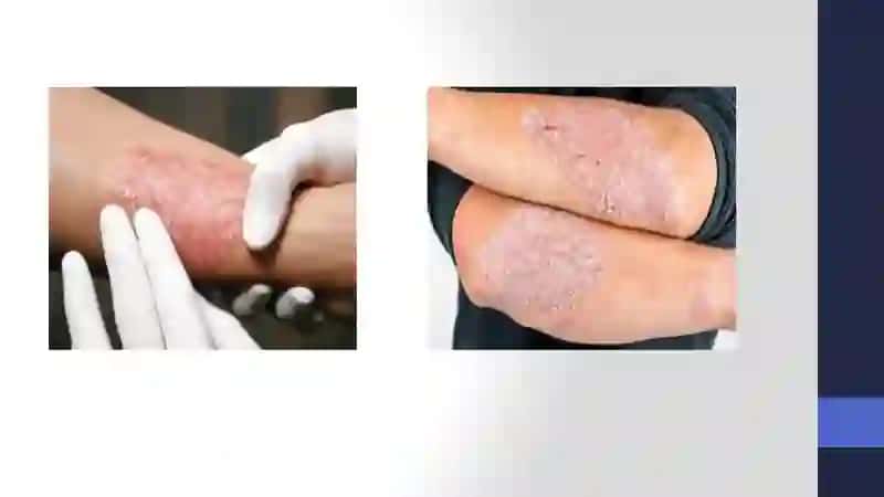 Psoriaz kasalligi haqida 4