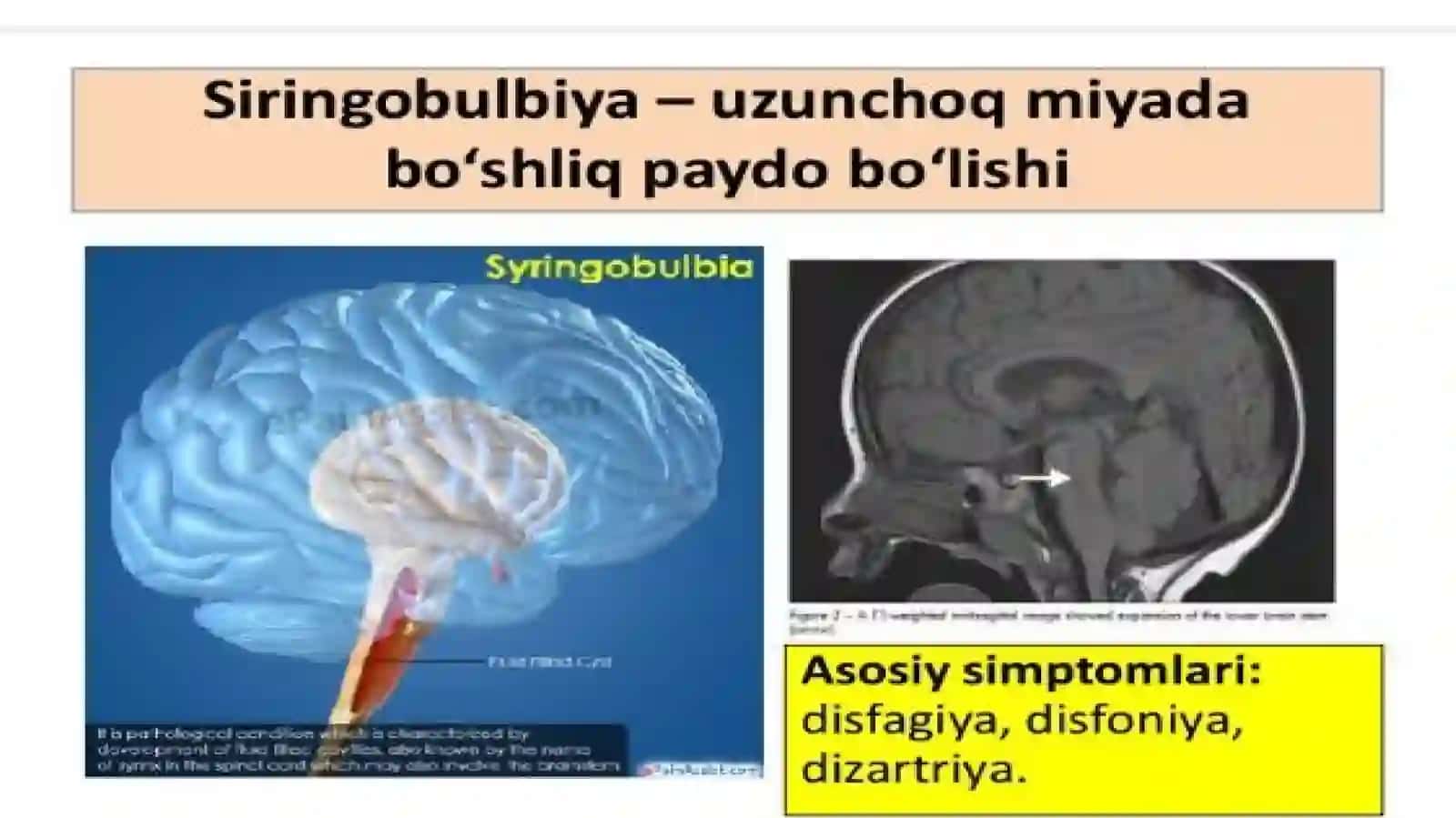 Siringomiyeliya 4
