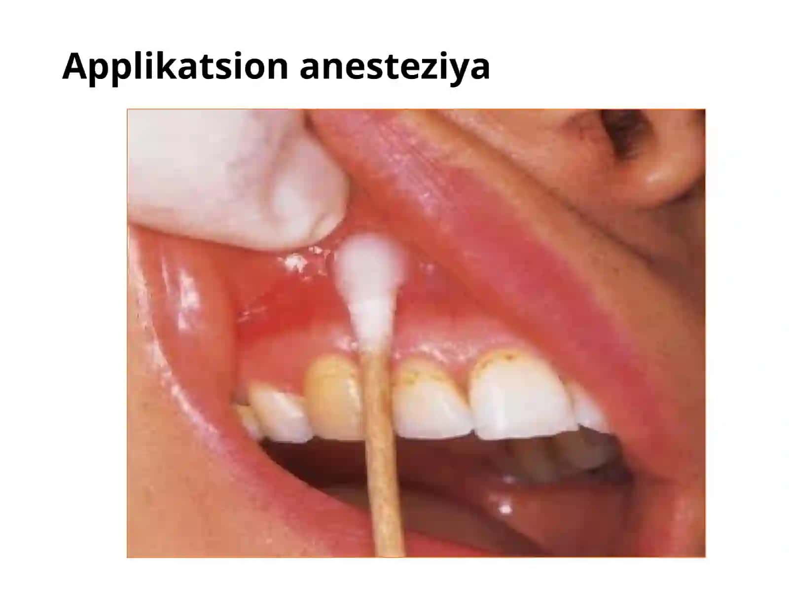 Terapevtik stomatologiyada ishlatiladigan anesteziya turlari 4