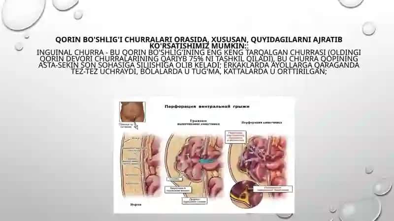 Qorin bo'shlig'i churralari 4