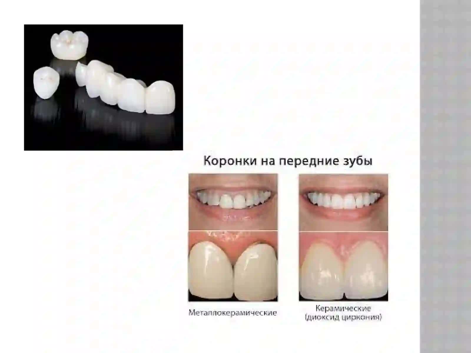dioksidsirkon 4